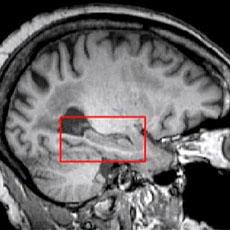 The hippocampus - the red block in another section of the brain - controls memory, and may also be affected by a stroke