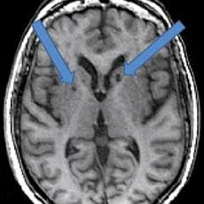 In this scan of a patient who has had two strokes, the arrows point to dark holes filled with fluid were once healthy cells killed by blood clots traveling to the brain