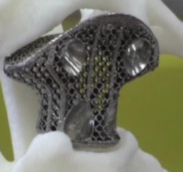 Chinese Doctors Use 3-D Spinal Implant